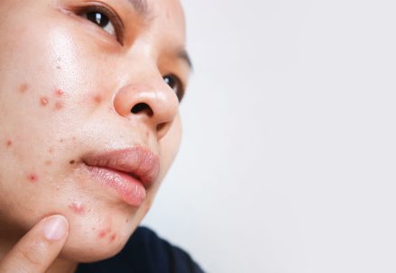 Transform Your Skin with Tretinoin: Before and After Photos