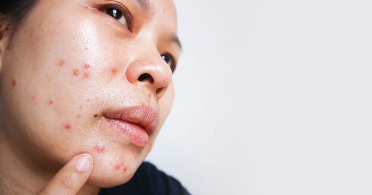 Transform Your Skin with Tretinoin: Before and After Photos